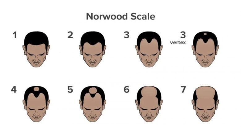 What is Causing Your Hair Fall? Take This Scientifically Backed Hair Loss Quiz