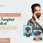 From Shedding to Visible Growth: Hair Transplant Results at 3, 6 and 12 Months